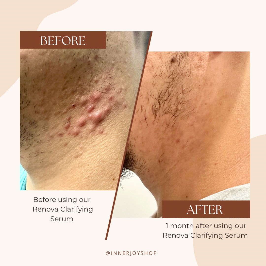 Before and After using Renova Clarifying Serum